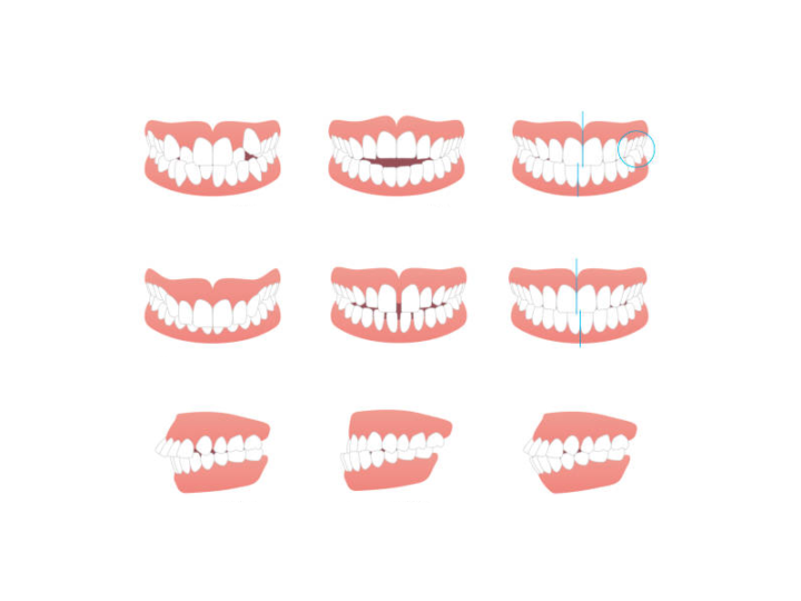 diferencia-entre-ortopedia-maxilar-y-ortodoncia-una-guia-completa imagen de artículo