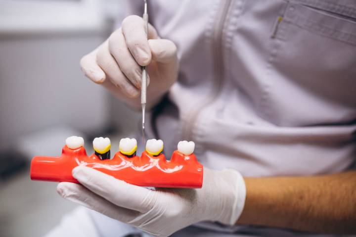 implantes-dentales-solucion-permanente-para-perdida-de-dientes imagen de artículo