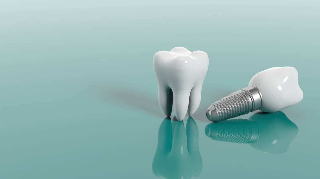 implantes-dentales-la-solucion-definitiva-para-reemplazar-dientes-faltantes imagen de artículo