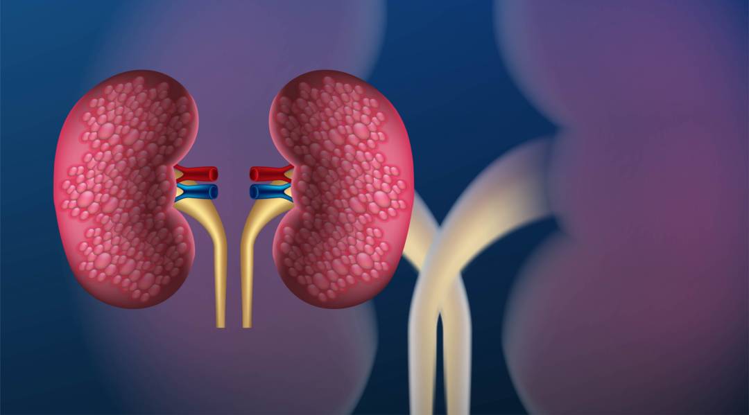 enfermedad-renal-cronica-conexion-oculta-diabetes-hipertension imagen de artículo