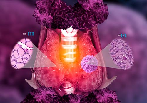 tratamiento-radioyodo-i-131-alternativa-manejo-cancer-tiroides imagen de artículo