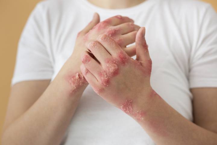 dermatomiositis-una-enfermedad-autoinmune-que-afecta-multiples-tejidos imagen de artículo