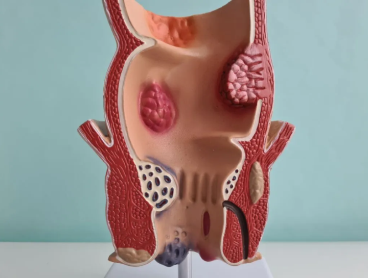 fistulas-anales-factores-de-riesgo-diagnostico-y-recuperacion imagen de artículo