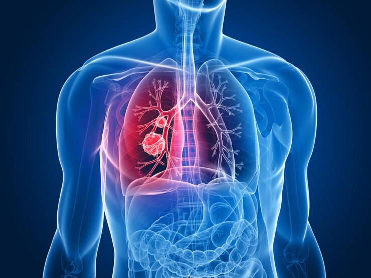 que-es-enfisema-pulmonar-como-afecta-pulmones imagen de artículo