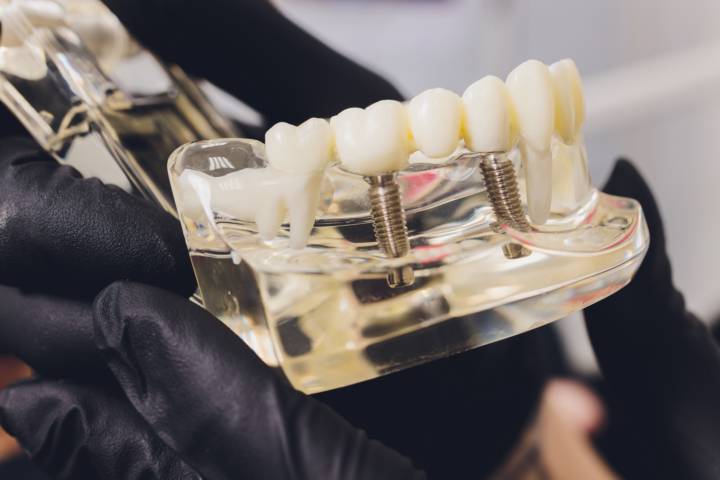 implantes-dentales-la-alternativa-fija-y-duradera-para-reemplazar-dientes-perdidos imagen de artículo