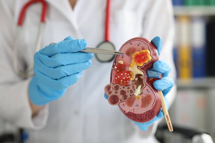 enfermedad-renal-cronica-que-es-como-detectarla-tratamientos imagen de artículo