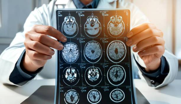 alzheimer-sintomas-tempranos-y-diagnostico-temprano imagen de artículo