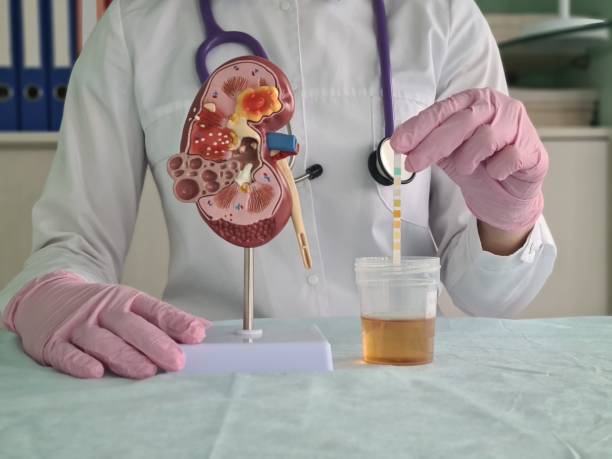 nefropatia-diabetica-una-amenaza-silenciosa-para-los-rinones imagen de artículo