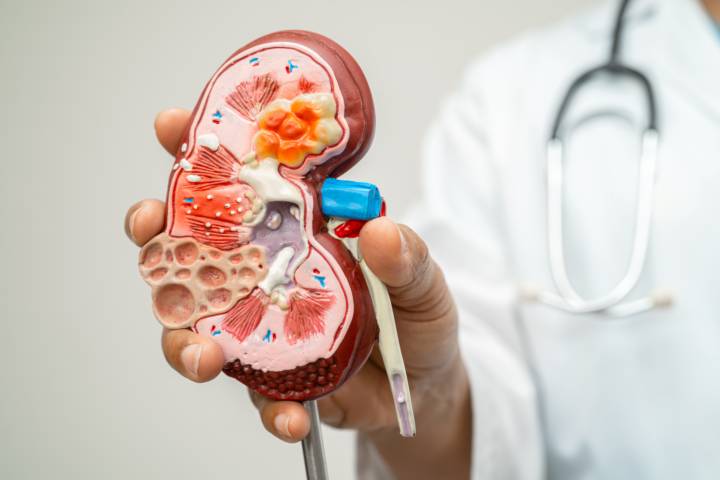 litiasis-via-urinaria-como-evitar-calculos-renales-mejorar-salud-urinaria imagen de artículo