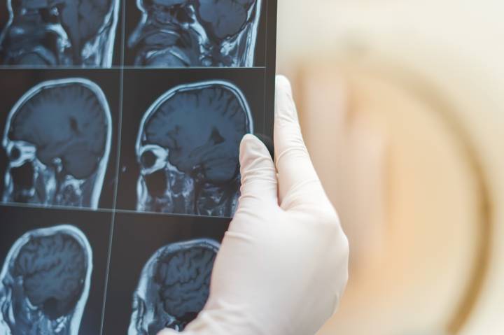 meningiomas-que-son-sintomas-cuando-pueden-ser-problema imagen de artículo