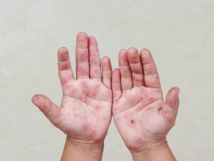 virus-coxsackie-que-es-cuales-son-sintomas-como-tratar-enfermedad imagen de artículo