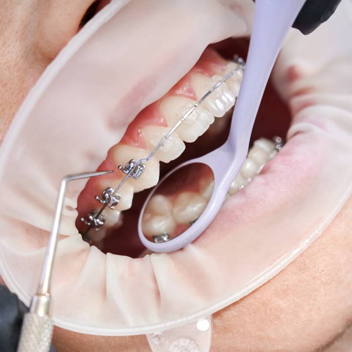 ortopedia-dentomaxilofacial-tratamiento-corrige-desarrollo-oseo-dental-ninos-adolescentes imagen de artículo