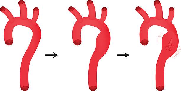 aneurismas-disecciones-de-aorta-emergencia-silenciosa imagen de artículo