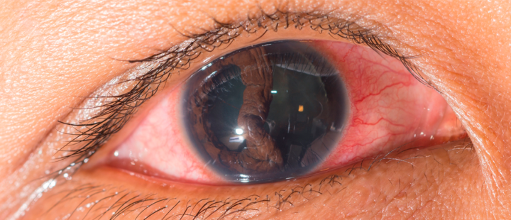 por-que-se-produce-el-desprendimiento-de-retina-y-como-tratarlo-a-tiempo imagen de artículo