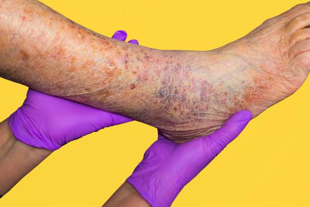 desafios-y-triunfos-la-vida-cotidiana-con-esclerodermia imagen de artículo