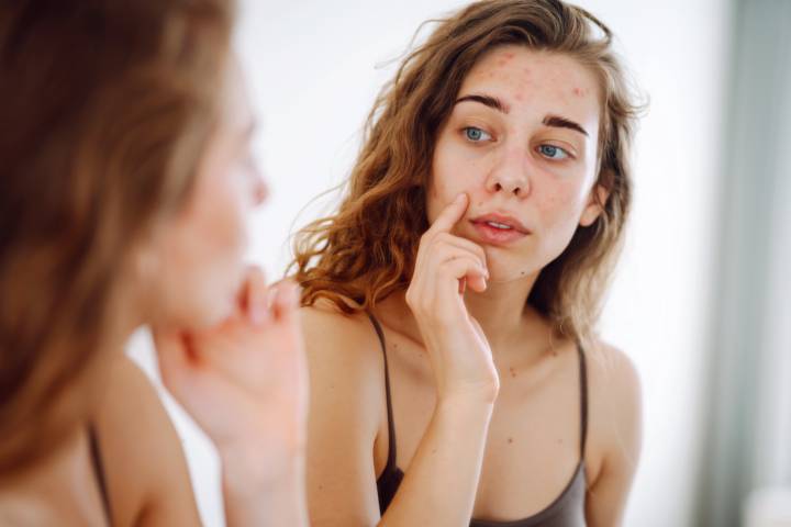 como-tratar-el-acne-en-sus-diferentes-etapas-desde-la-prevencion-hasta-las-cicatrices imagen de artículo