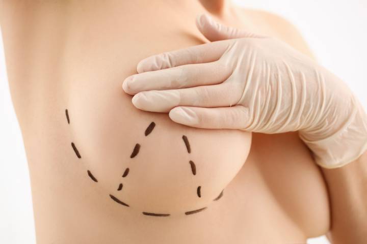 mastopexia-cirugia-para-levantar-rejuvenecer-senos imagen de artículo