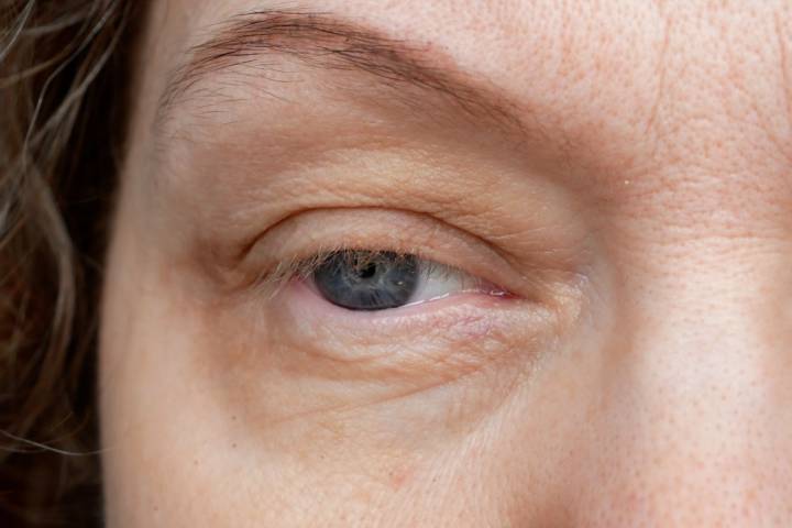 parpados-caidos-causas-tipos-tratamientos-ptosis-palpebral imagen de artículo