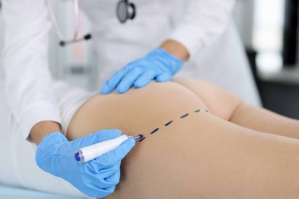 realza-tu-figura-descubre-el-mundo-de-los-implantes-de-gluteos imagen de artículo