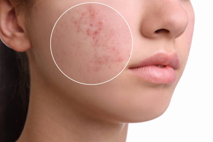 acne-que-son-granos-ciegos-como-eliminarlos imagen de artículo