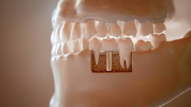 all-on-four-nueva-forma-implantes-dentales imagen de artículo
