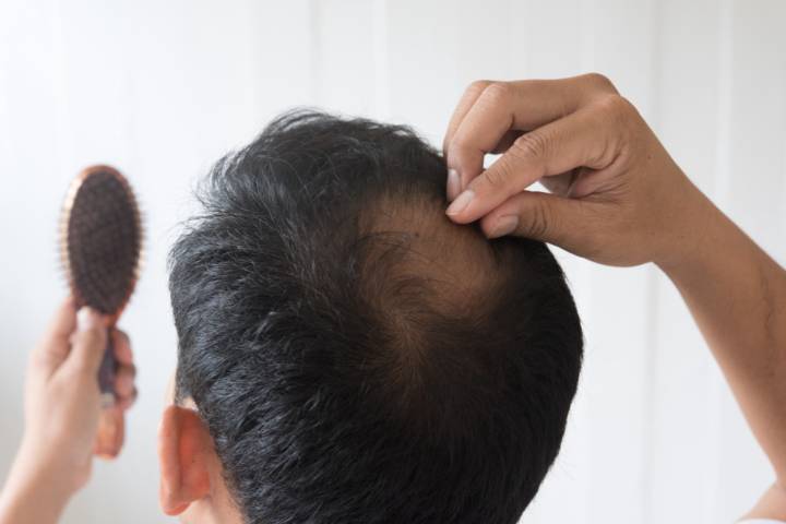 una-caida-va-mas-alla-cabello-impacto-invisible-alopecia-areata imagen de artículo
