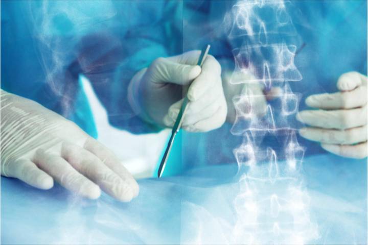 cirugia-endoscopica-columna-opcion-minimamente-invasiva-aliviar-dolor-espalda-cronico imagen de artículo
