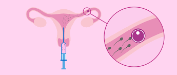 inseminacion-intrauterina-apoyo-en-el-viaje-reproductivo imagen de artículo