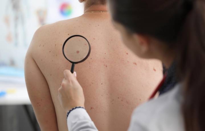 cancer-de-piel-tipos-factores-riesgo-senales-alarma imagen de artículo