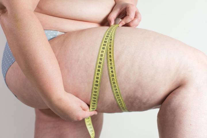 lipedema-enfermedad-cronica-afecta-calidad-vida imagen de artículo