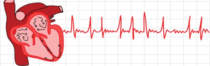 arritmias-cardiacas-como-detectar imagen de artículo