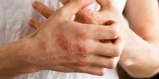 Dermatitis alérgica por contacto