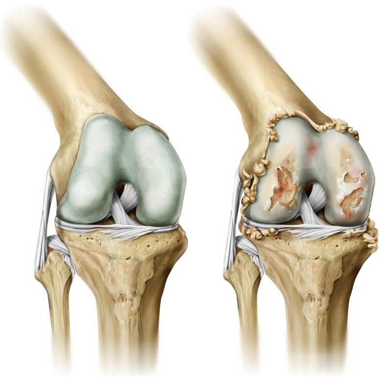 Artrosis de Rodilla