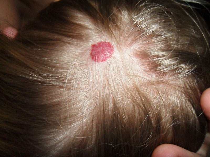 hemangioma