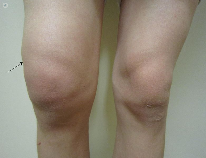 Artrosis de rodilla: Pronóstico y síntomas