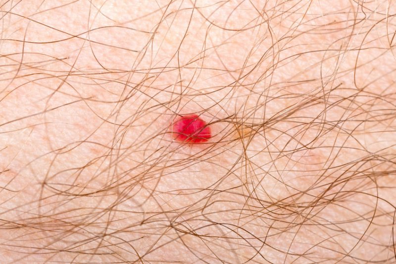 Angioma