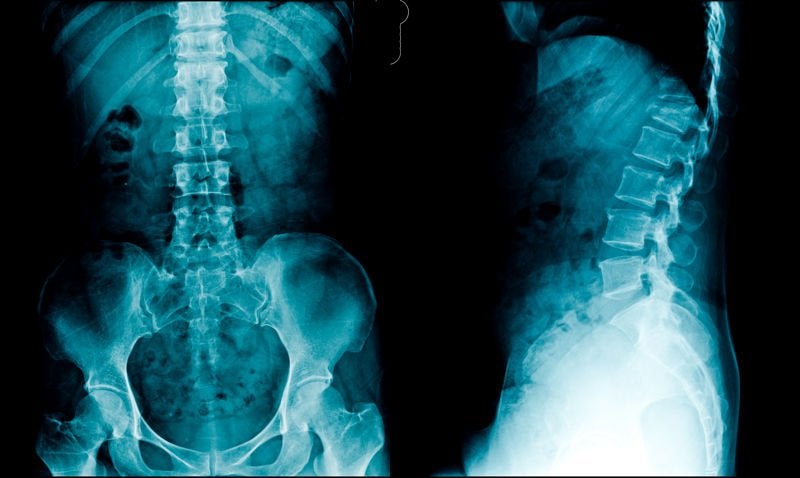 Radiografía lateral de columna lumbosacra, donde se observa tumoración
