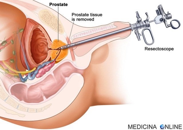 Biopsia de Prostata