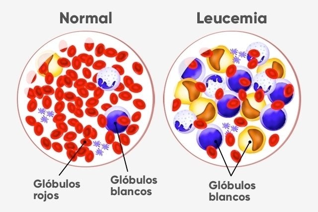¿Qué es la leucemia?