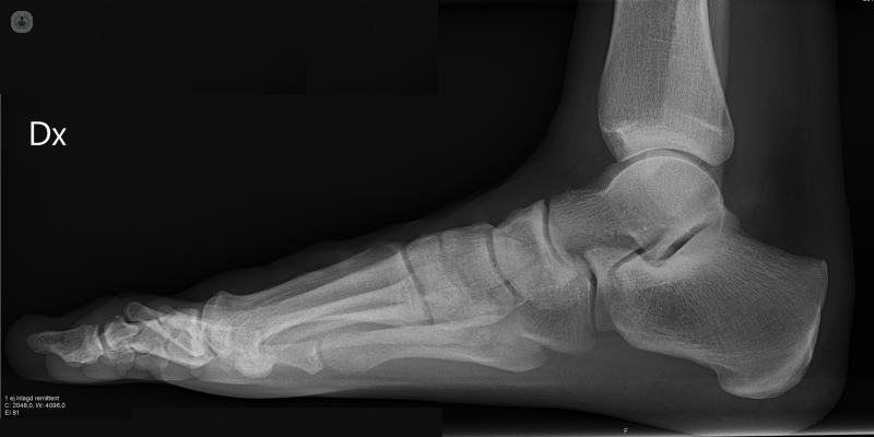 artrodesis de pie