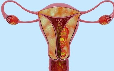 Causas del cáncer de endometrio
