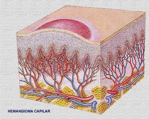 Hemangiomas y Malformaciones Vasculares