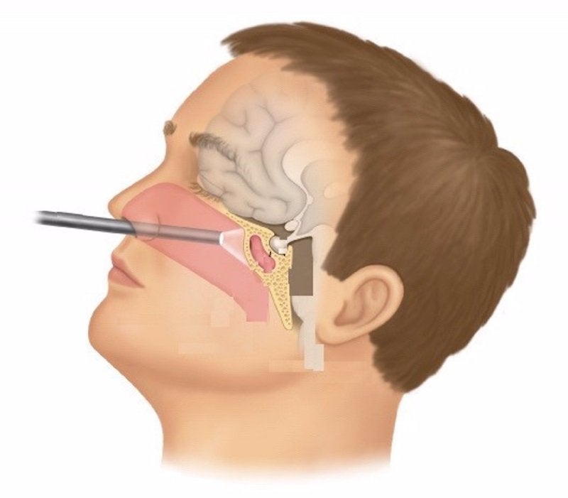 Cirugía Endoscópica de Cráneo