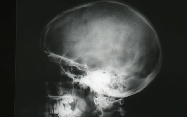 ¿Qué es un fractura de cráneo?