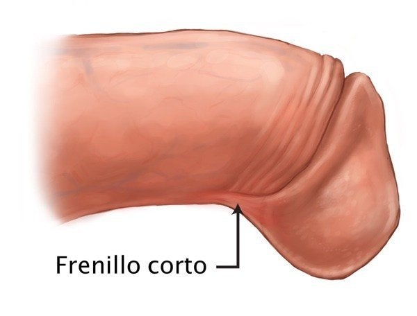 Frenillo Corto