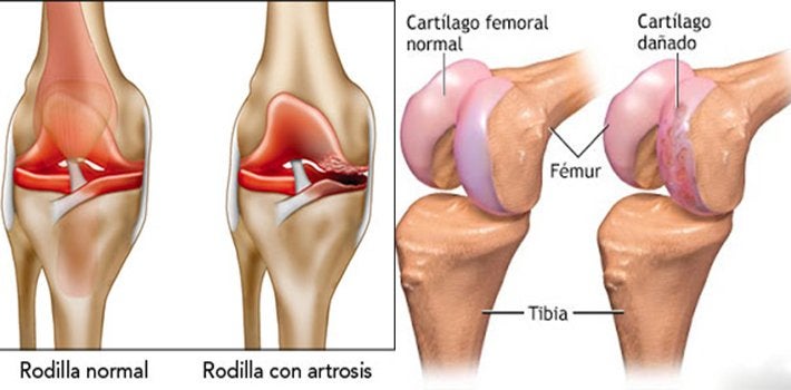 Artrosis de Rodilla
