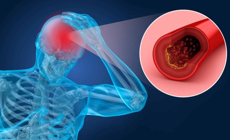 Derrame Cerebral Coronavirus