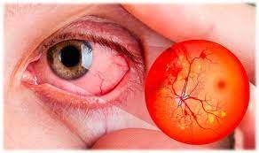 retinopatia diabetica gpc