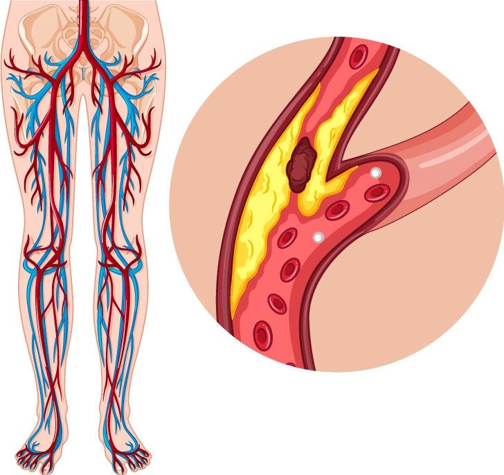 Arteriopatía Periférica