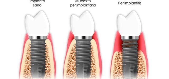 Periimplantitis 